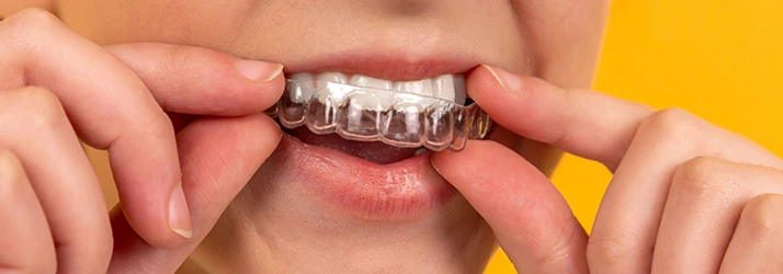 FC – Dental Retainers In O’Fallon MO