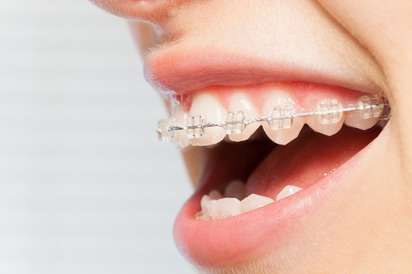 FAQs About Ceramic Braces For Kids